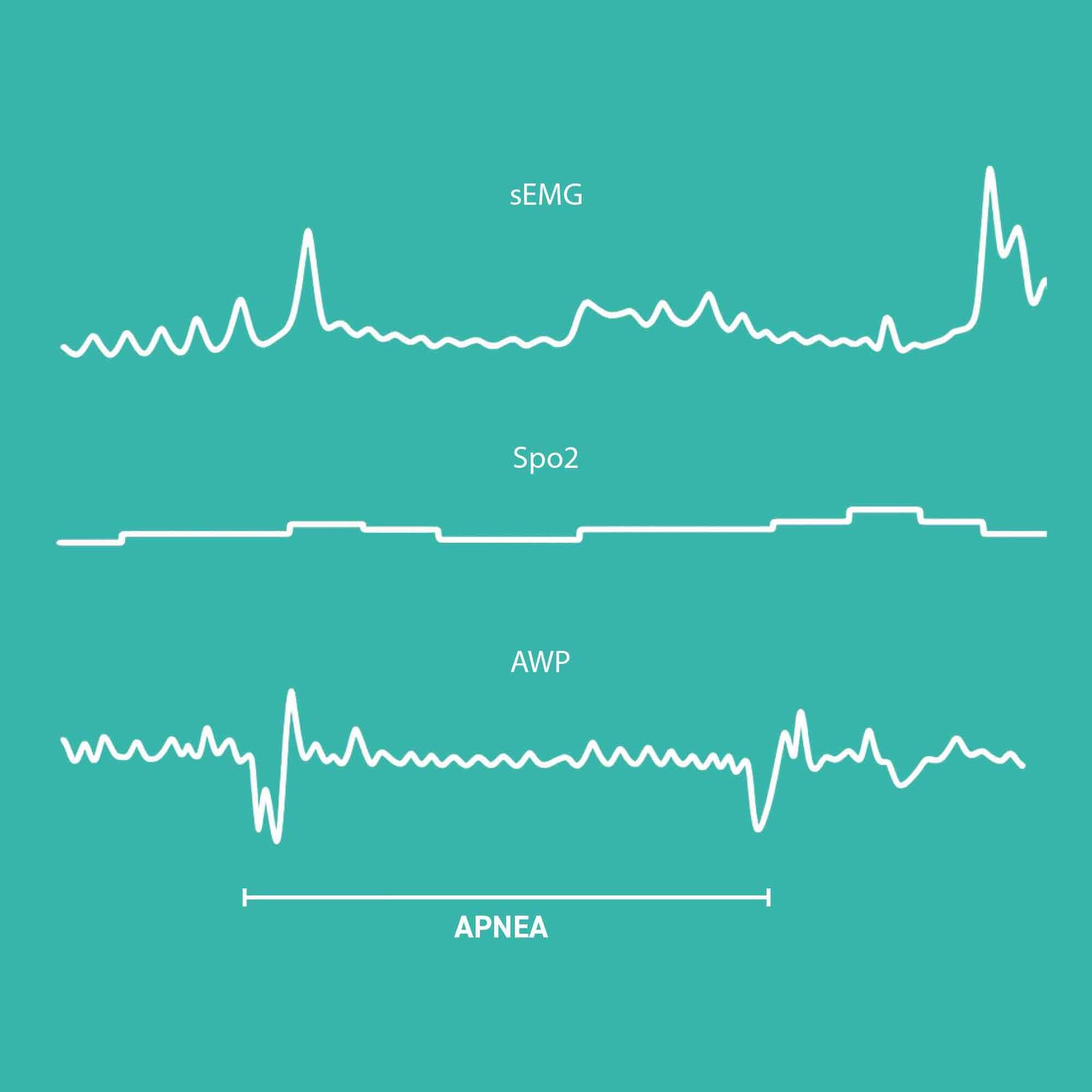 demcon-macawi-apnea-detection